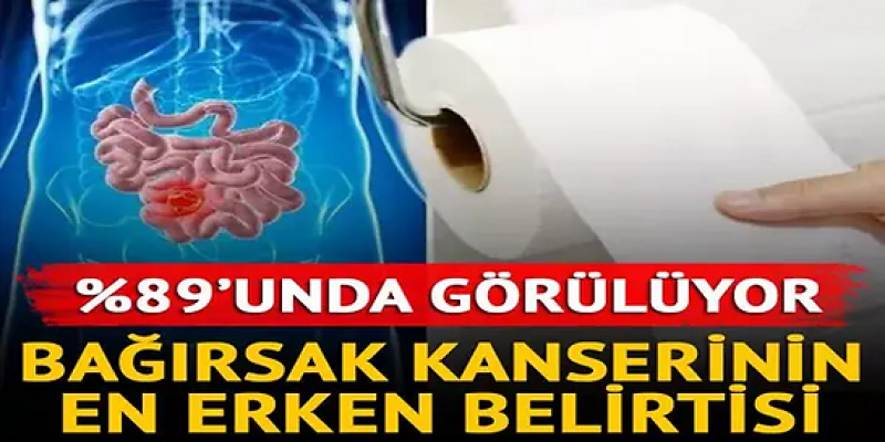 Bağırsak kanserinin en erken belirtisi: %89'unda görülüyor