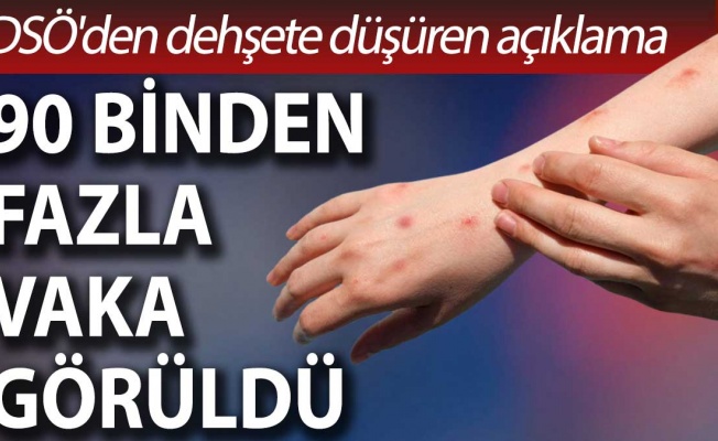 DSÖ: Dünya genelinde 90 binden fazla o virüsü vakası görüldü